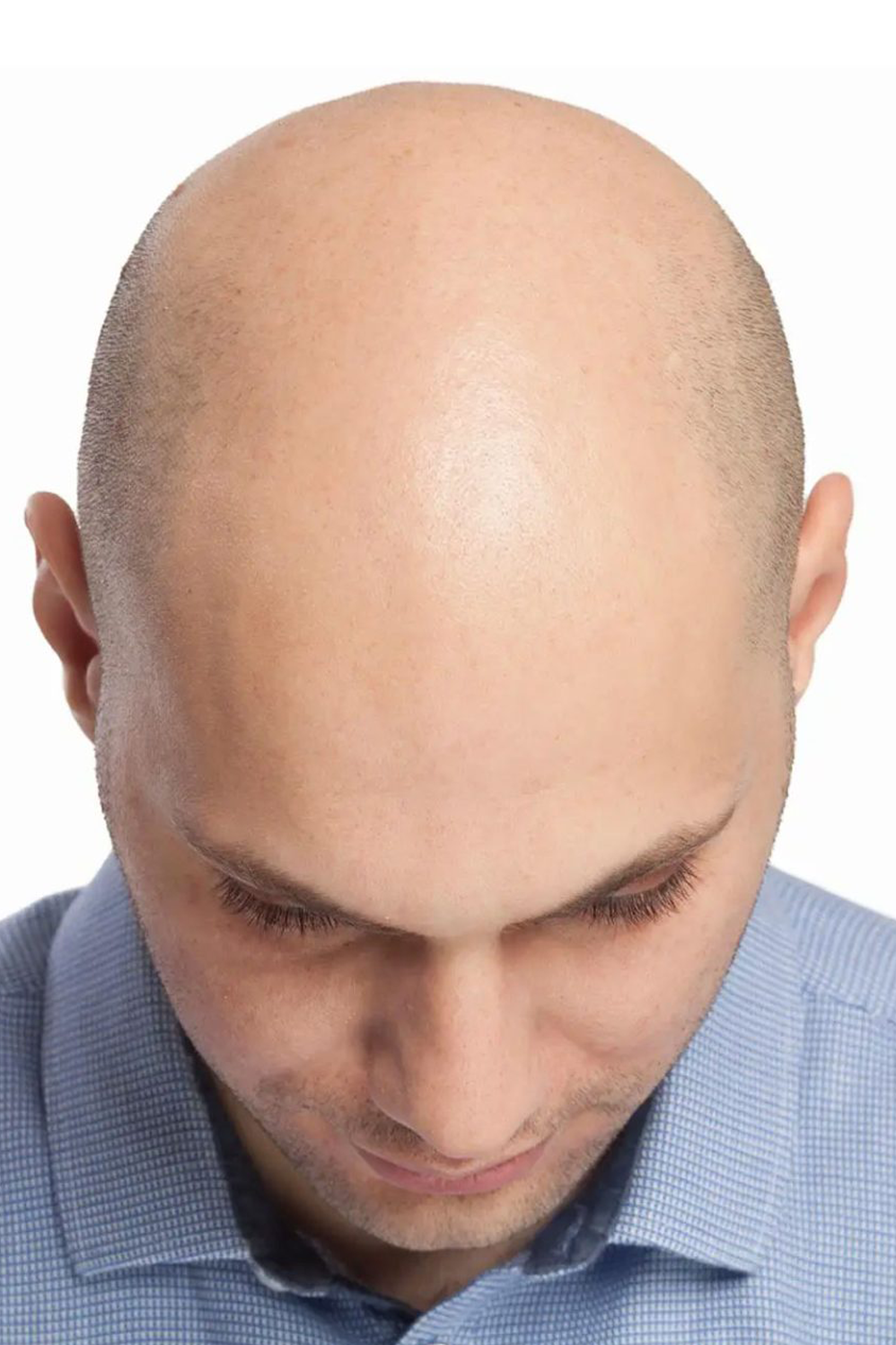 Comprendiendo la Alopecia: Causas y Síntomas
