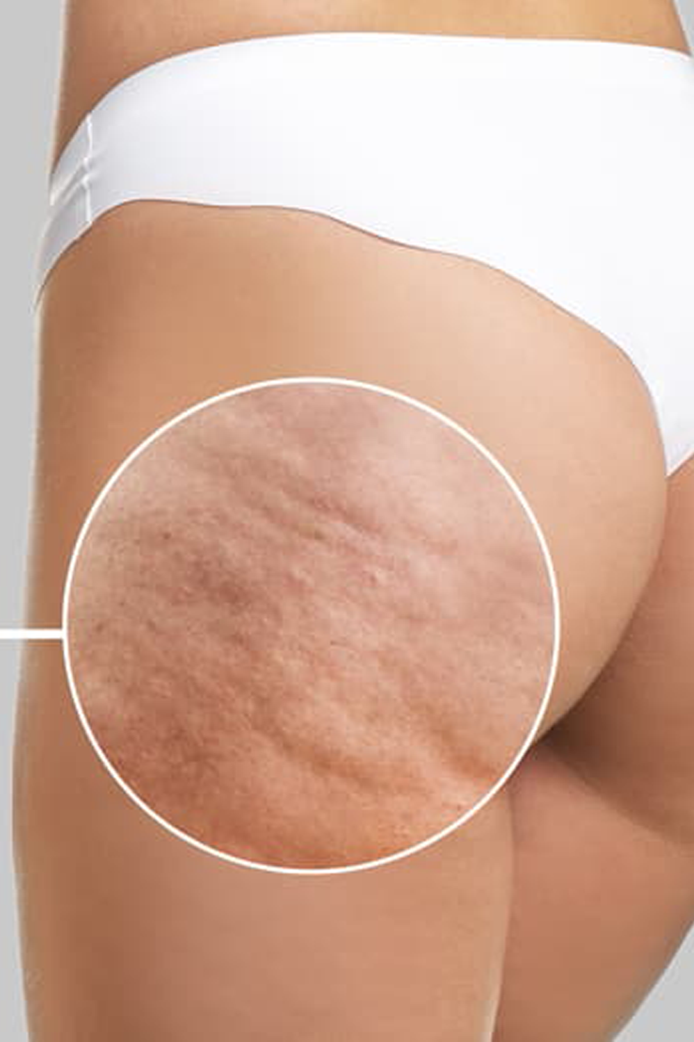 Celulitis y Piel De Naranja