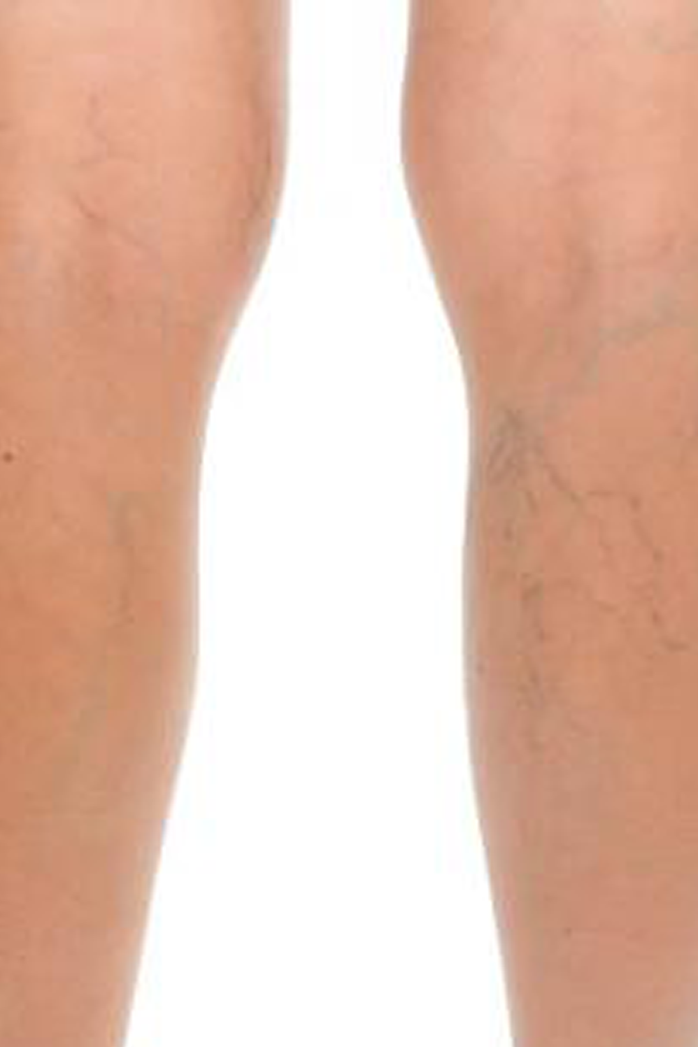 Comprendiendo las Varices