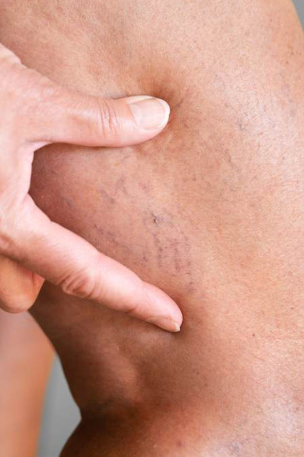 Varices: Tratamiento con Láser para Resultados Óptimos