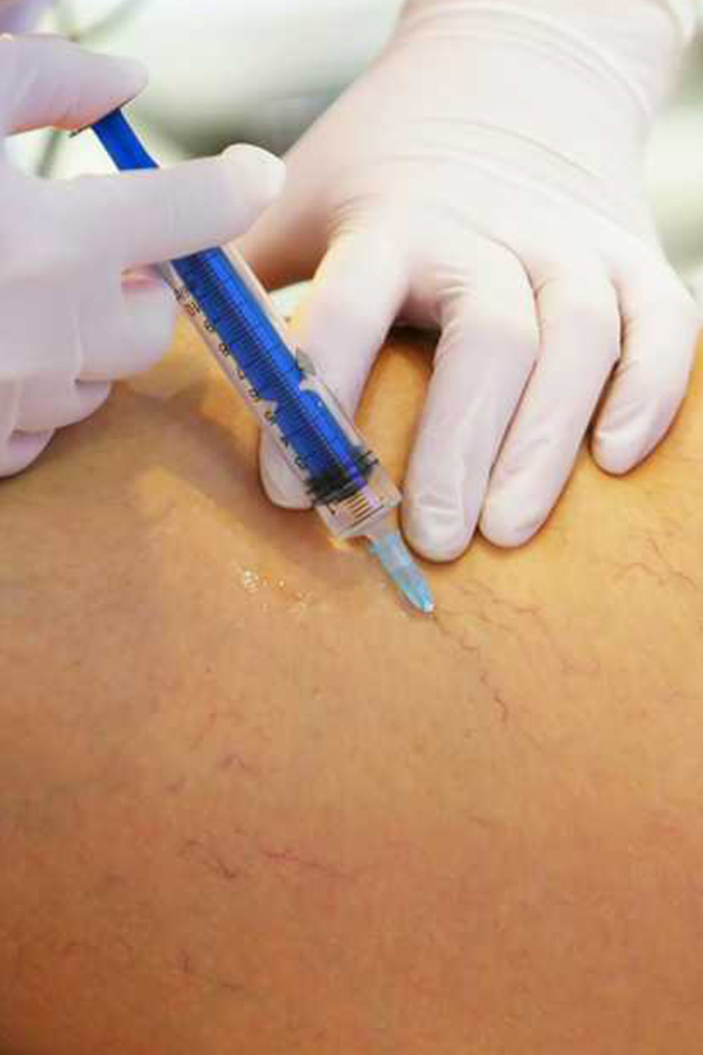 Técnica de Esclerosis Vascular